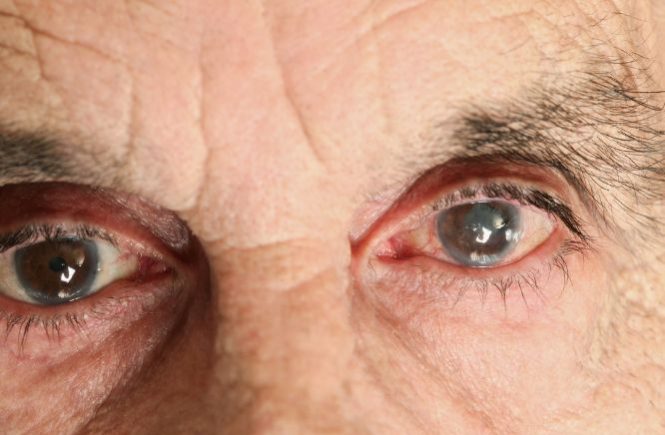 The Signs & Symptoms Of Glaucoma: What To Do